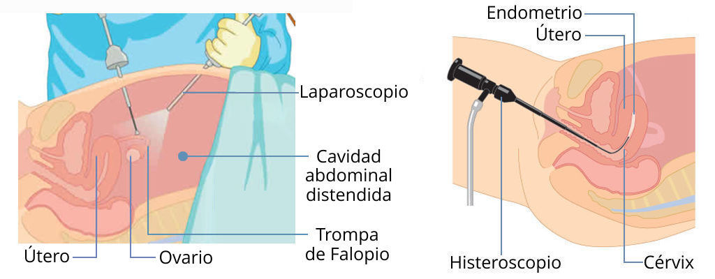 cirugía endoscópica ginecológica